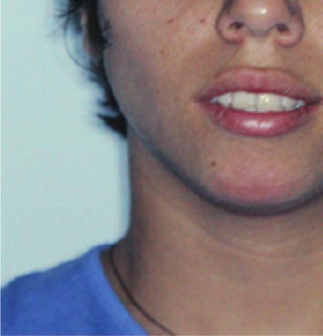 The extraoral examination pointed out to slight facial asymmetry, convex profile, and absence of passive lip sealing (Figure 1). No signs and symptoms of TMJ dysfunction were indicated.