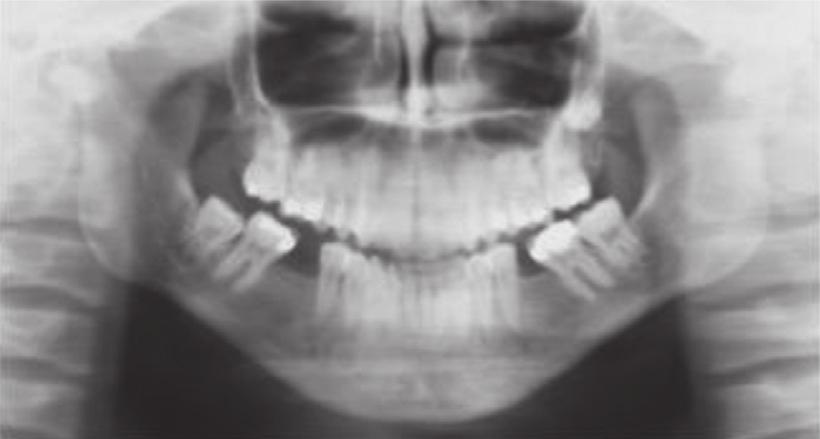 4 CaseReportsinDentistry Figure 3: Pretreatment panoramic and lateral radiographs at 19 years, 0 month. Table 1: Cephalometric measurements at initial, debonding, and 6-year follow-up stages.