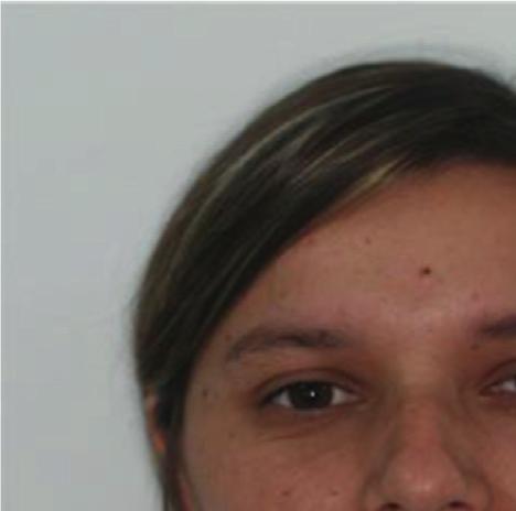 CaseReportsinDentistry 5 Figure 5: Posttreatment facial photographs (22 years, 1 month).