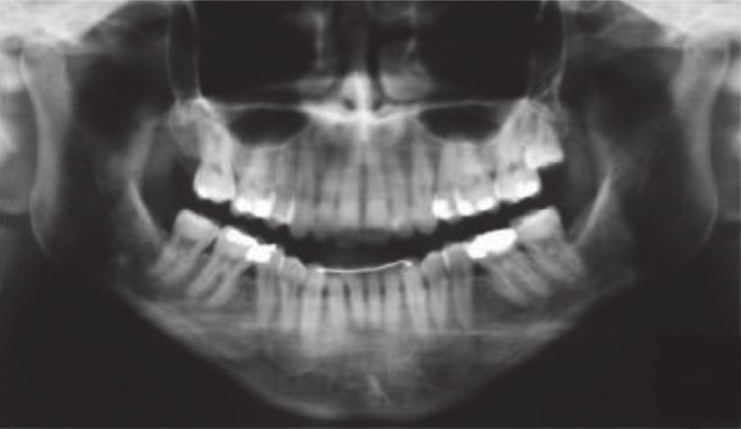 CaseReportsinDentistry 7 Figure 7: Posttreatment panoramic and