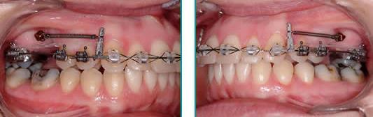 routinely available in orthodontics and these provide further options in the management of first