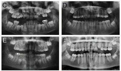 All four permanent molars were compromised and subsequently extracted, which resulted in 7 s