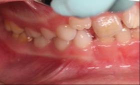 buccal occlusion left and
