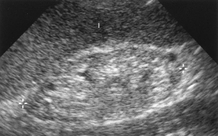 Renal ultrasound liver Small (7 cm),