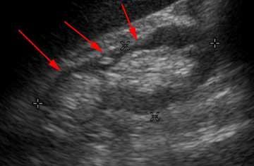Renal ultrasound Kidney with uneven surface