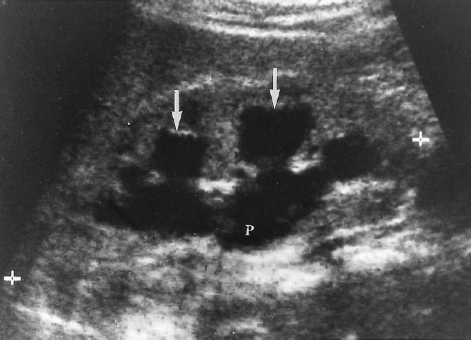 Renal ultrasound