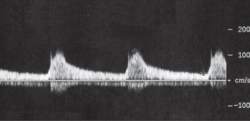 Renal ultrasound Renal artery Doppler