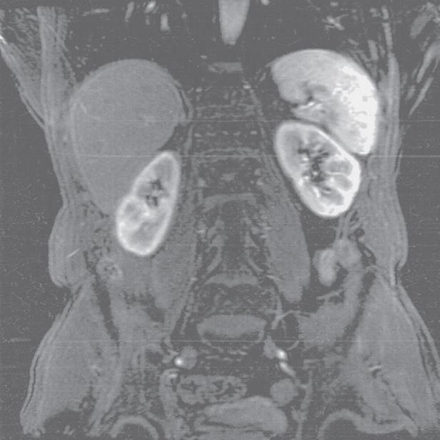 Renal MRI Indications: - Usually not first-line investigation - non-calculosus