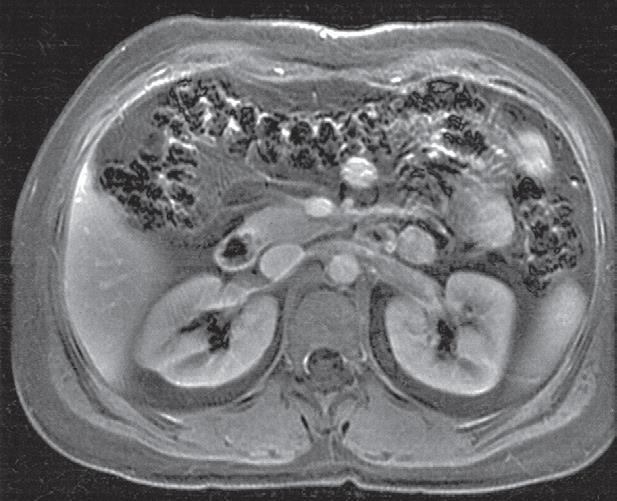 Limitations: MR contrast material should NOT be given: - Severe renal impairment