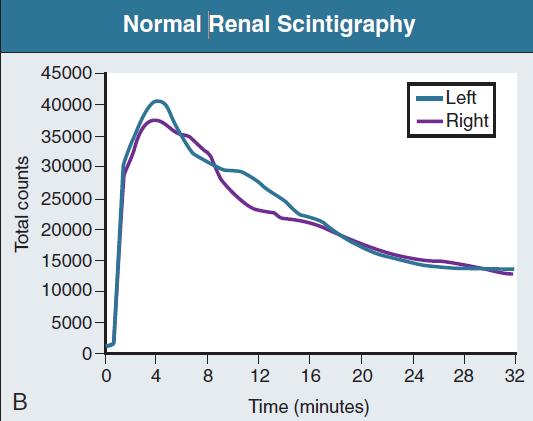 Renal scintigraphy Indications: - studying renal blood flow and function -