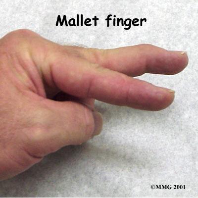 mechanism Always x-ray Mallet Finger Treatment