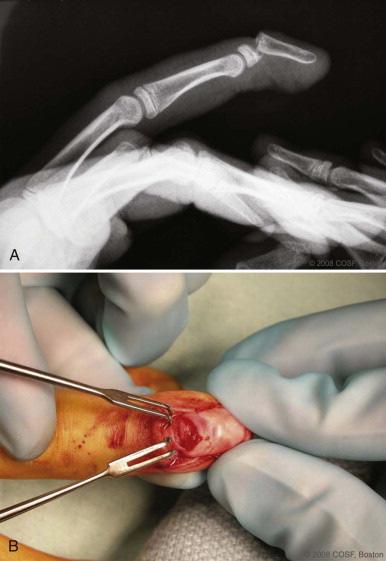 Epiphyseal Fracture of the Distal Phalanx- Seymour Fracture Hyperflexion Injury Open