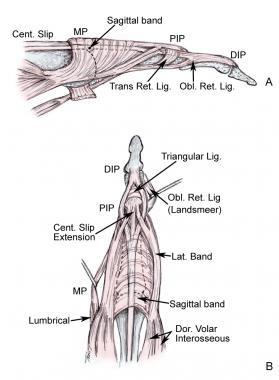 Injury The sagittal band hold the terminal extensor tendon in