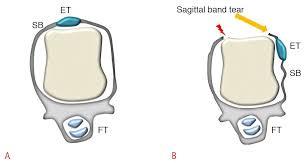 tendon will sublux Middle finger most affected Often due to