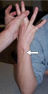 and ULNAR DEVIATION at the wrist against resistance Synergy Test Xray/MRI essential ECU tendonitis evaulation ECU