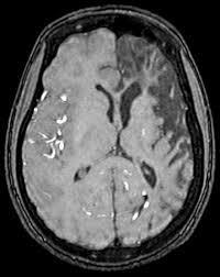 Brain TIA, CVA -> strokes (2-11yrs) (10% before age