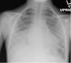Lungs Acute chest syndrome (ACS) Fever, cough, chest pain, dyspnoea, wheeze Pulm infiltrates (CXR) Vaso-occlusion, fat embolism, pulmonary thromboembolism, infection