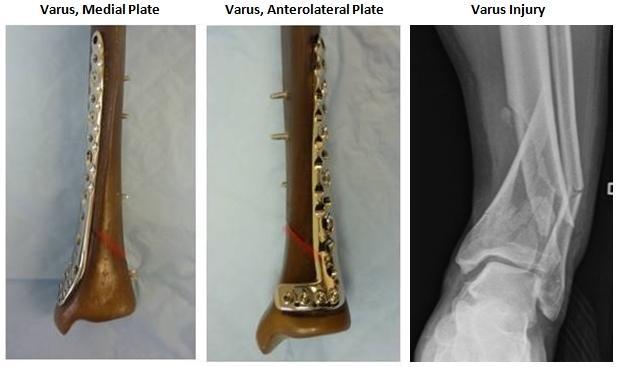 16 4 th generation tibia bone models with simulated