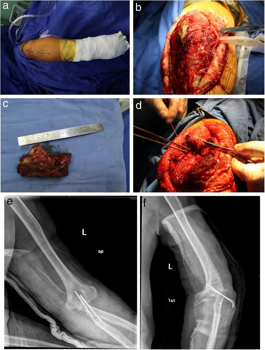 Chen et al. European Journal of Medical Research 2012, 17:23 Page 4 of 8 Figure 4 (a) Posterior incision including the biopsy site. (b) Exposure and preservation of the ulnar nerve.