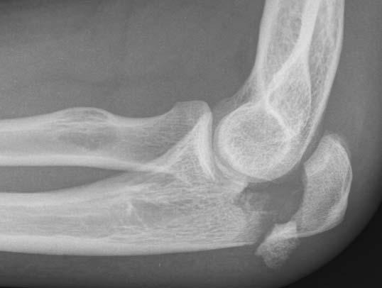 Elbow (Distal Humerus, Olecranon) Make sure that the joint is not