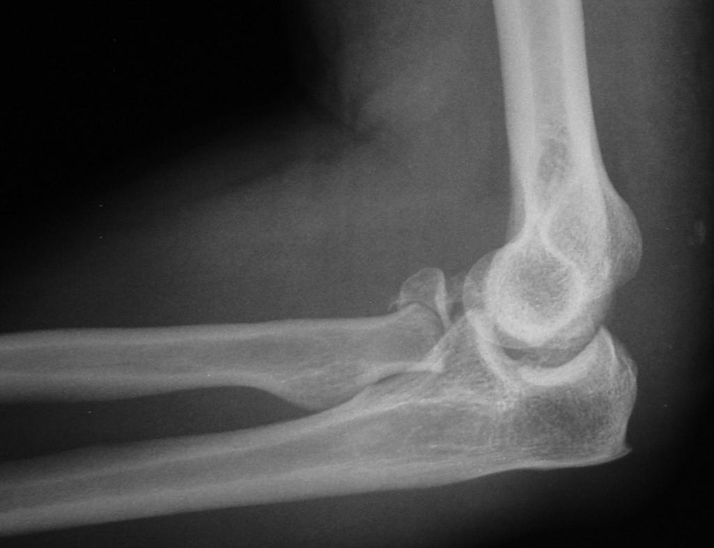 Radial Head Fractures Tenderness at lateral elbow, pain with
