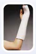 Metacarpal fractures Short Arm Splint extending to