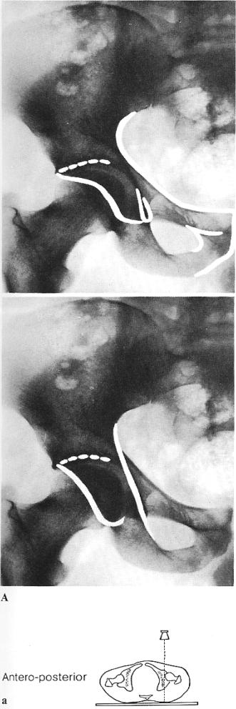 RADIOLOGY OF THE NORMAL ACETABULUM Six radiological landmarks should be recognized on the Anterior