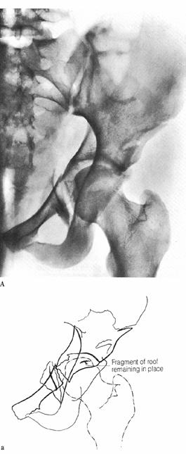 subluxated anterior w/ fragment Intermediate (anterior interspinous notch) Femoral head