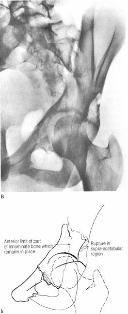 fragment AP OBTURATOR ILIAC AP Radiograph Disruption of iliopectineal line Fracture of the