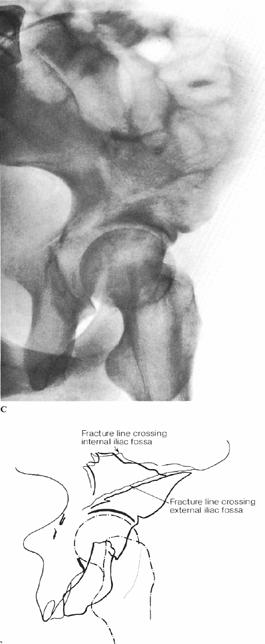 disruption of iliopectineal line Demonstrates anterior column displacement by femoral head