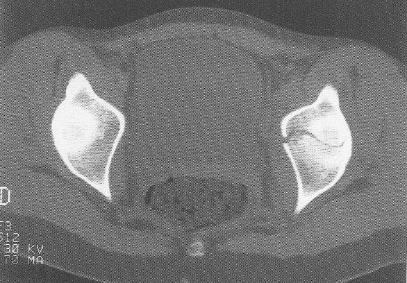 Incongruent or unstable hip joint 3.
