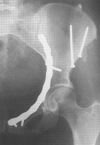 Reduce fracture at exit point from innominate bone