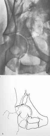 of roof attached to iliac wing inferior-pubic ramus fracture noted Obturator oblique Fracture of inferior-pubic ramus confirmed Iliopectineal line