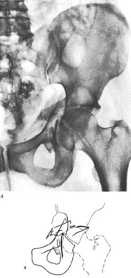 mimics transverse acetabular fracture Both column- no part of articular surface is attached to