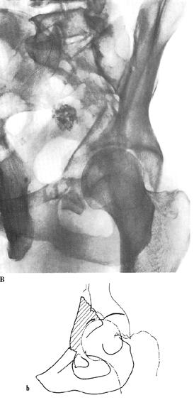 is as elementary anterior column/anterior wall fracture other than low type Femoral head follows