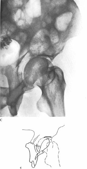 oblique Iliopectineal line disrupted in one or more locations Point of rupture of posterior