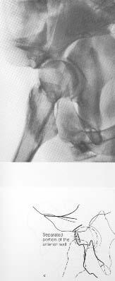 AP Radiographs All 6 acetabular landmarks disrupted Central displacement of femoral head Inward displacement of posterior column Tilted and displaced acetabular roof Iliac wing fracture Fracture of