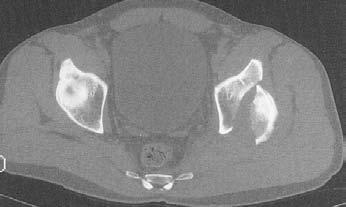 POSTERIOR WALL FRAURES - 2 Surgical Indications 1.