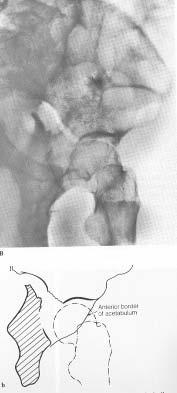 displacement of femoral head AP OBTURATOR ILIAC AP Radiograph Ilioischial line disrupted Posterior column &