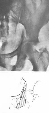 Teardrop is intact Judet Radiographs Obturator oblique Intact anterior column Ilioischial line is