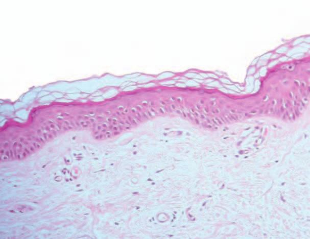 Fast Facts Eczema and Contact Dermatitis Epidermis Stratum corneum (keratin layer) Stratum granulosum (granular cell layer) Stratum spinosum (prickle cell layer) Dermo-epidermal junction (basement