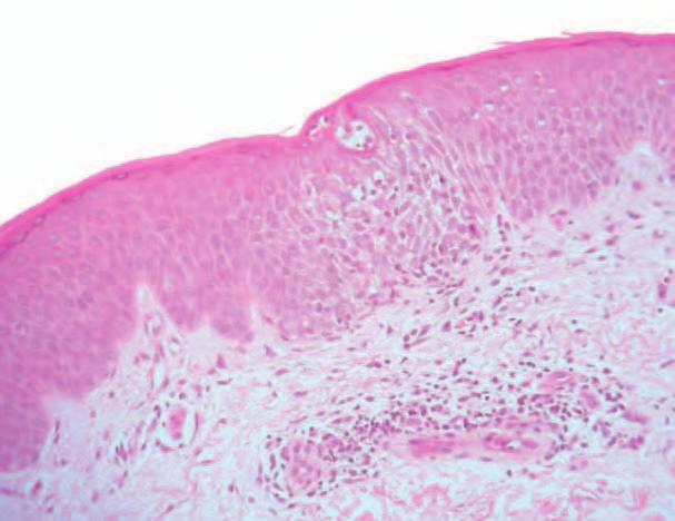 Introduction Epidermis Edema Dermis Lymphocytes and macrophages Figure 2 Histological appearance of eczematous skin.