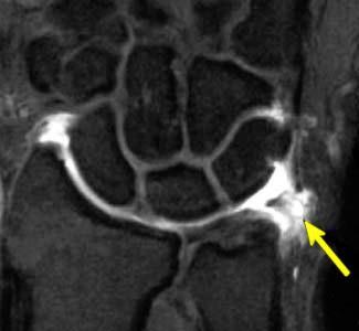 CT through Lister s tubercle A - symptomatic B -