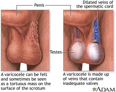 What are Varicoceles? A varicocele is when veins become enlarged inside your scrotum (the pouch of skin that holds your testicles). These veins are called the pampiniform plexus.