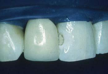 Etched surface Tooth is dried with air Enamel has