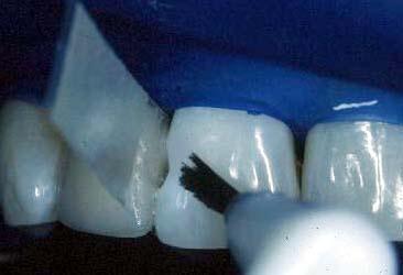 Application of adhesive Single component (Optibond Solo) Apply matrix and wedge Apply single component adhesive with brush or microbrush Rub into dentin surface Let sit on surfaces 5 seconds Gentle