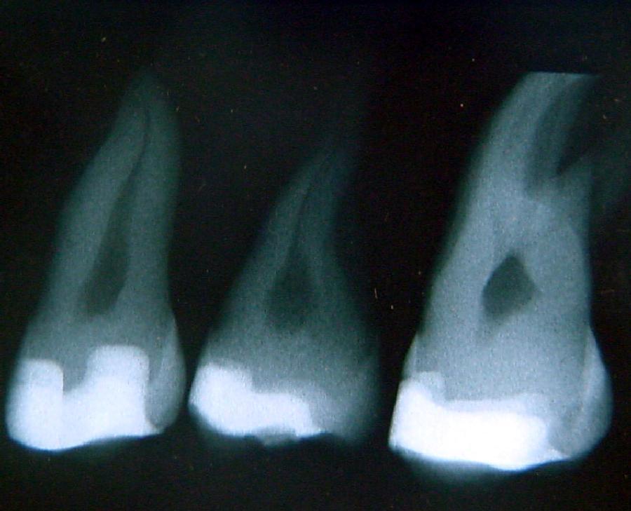 X-ray opacity of flowables Some dentists use flowable as liners in