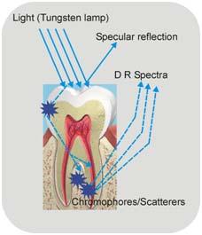 48 Spectroscopic Investigation of Tooth Caries and Demineralization oral bacteria and its level increases as the dental bio film becomes more mature, which is responsible for the red fluorescence in