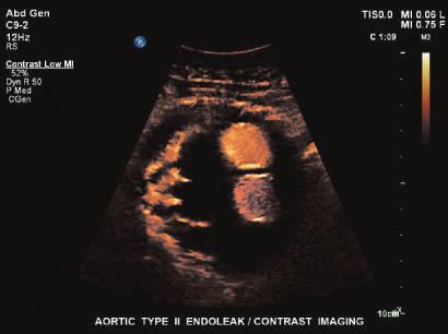 Among leading ultrasound manufacturers, Philips offers the world s only live 3D contrast system for general