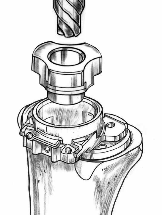 Use the Stem Extender Rod, attached to a Trial Stem Extender, through the Alignment Reamer Guide and Neutral Bushing to center the Template with the Stem construct in the canal (Figure 13).